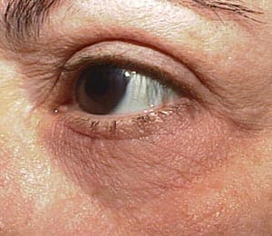 Laser resurfacing โ pre-operative assessment