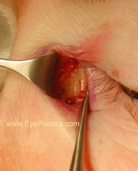 Incision