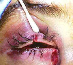 This photo below shows a patient who was hit in their right eye with a fist and who sustained a canalicular laceration.