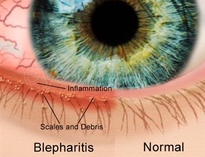 Blepharitis Staphylococcal blepharitis